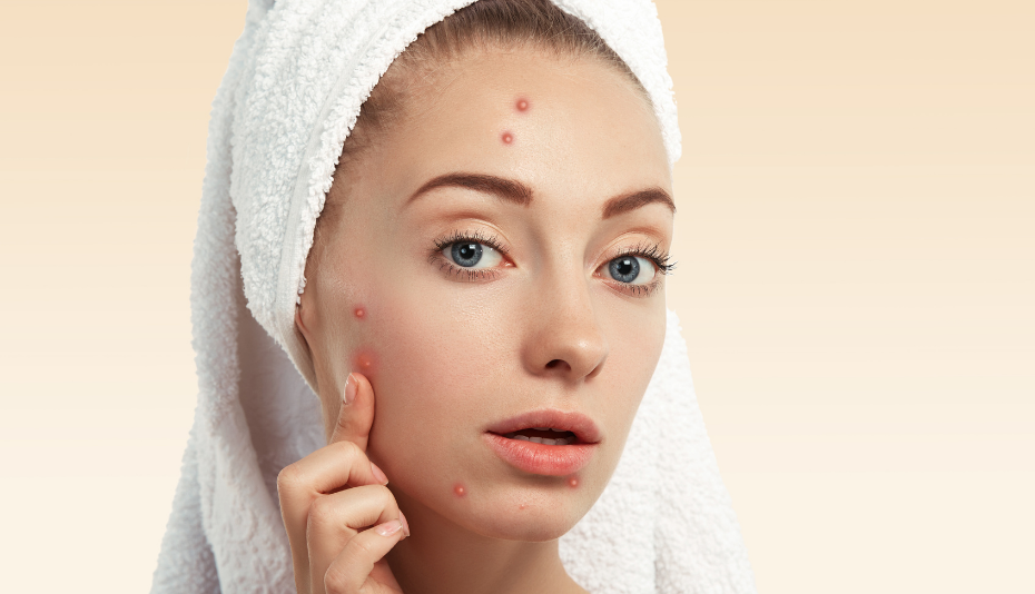 Say Goodbye to Blemishes, Acne Scars and Skin Problems with Candela PicoWay!
