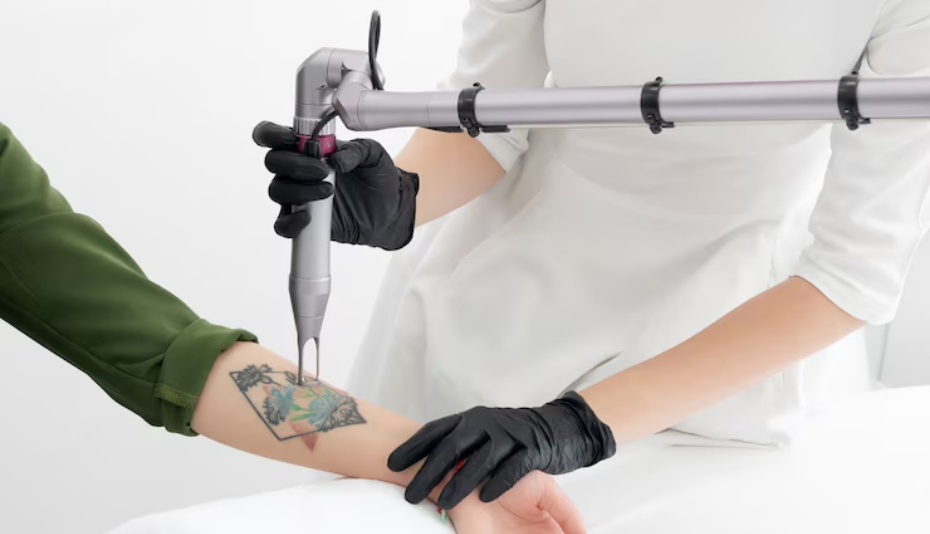 Why PicoWay Laser is the Best Option for Tattoo Removal?