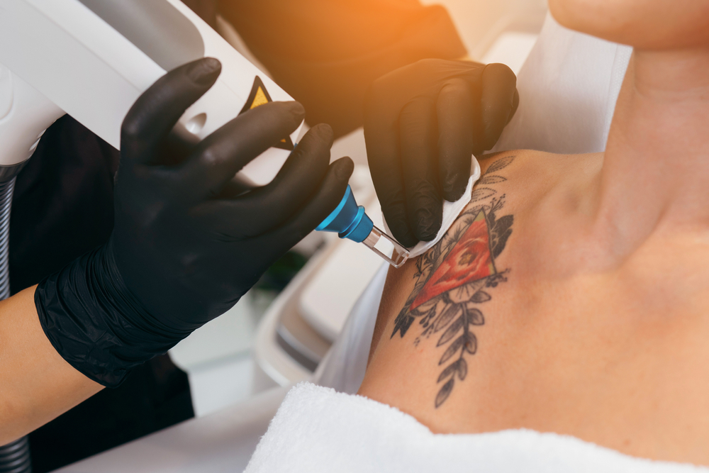 Details of Tattoo Laser Treatment Information About Tattoo Laser Treatment