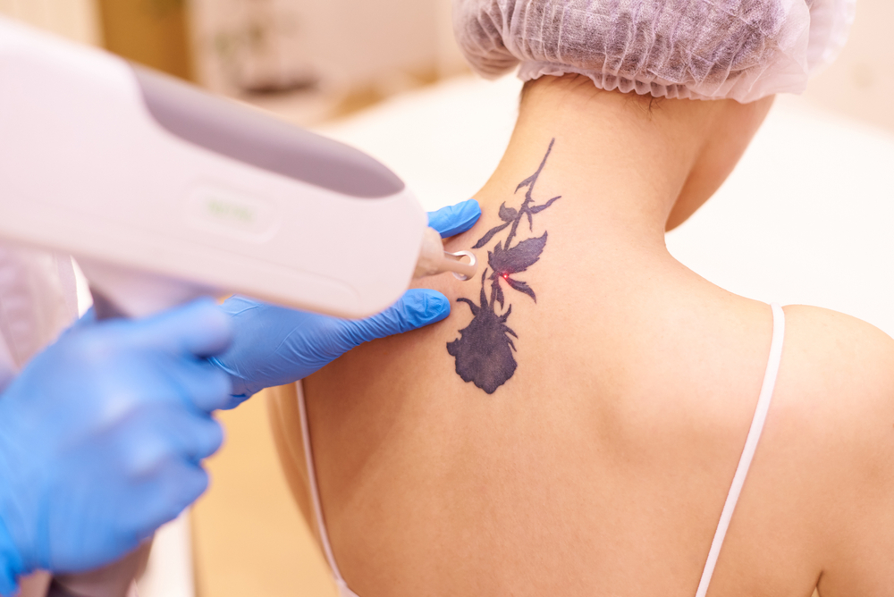 Everything You Need to Know About Tattoo Removal
