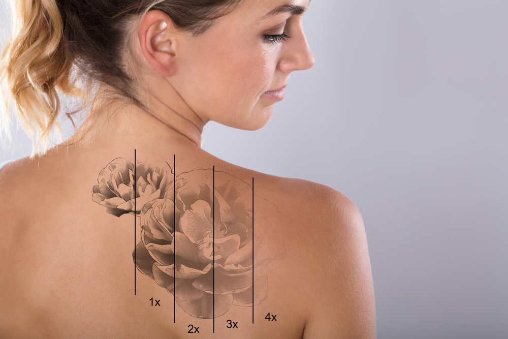 Informations About Tattoo Removal ve Pricing
