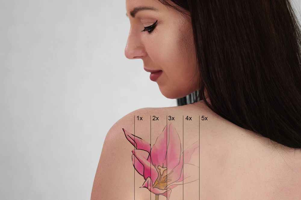 Details About Tattoo Removal Methods Information About Different Tattoo Removal Methods