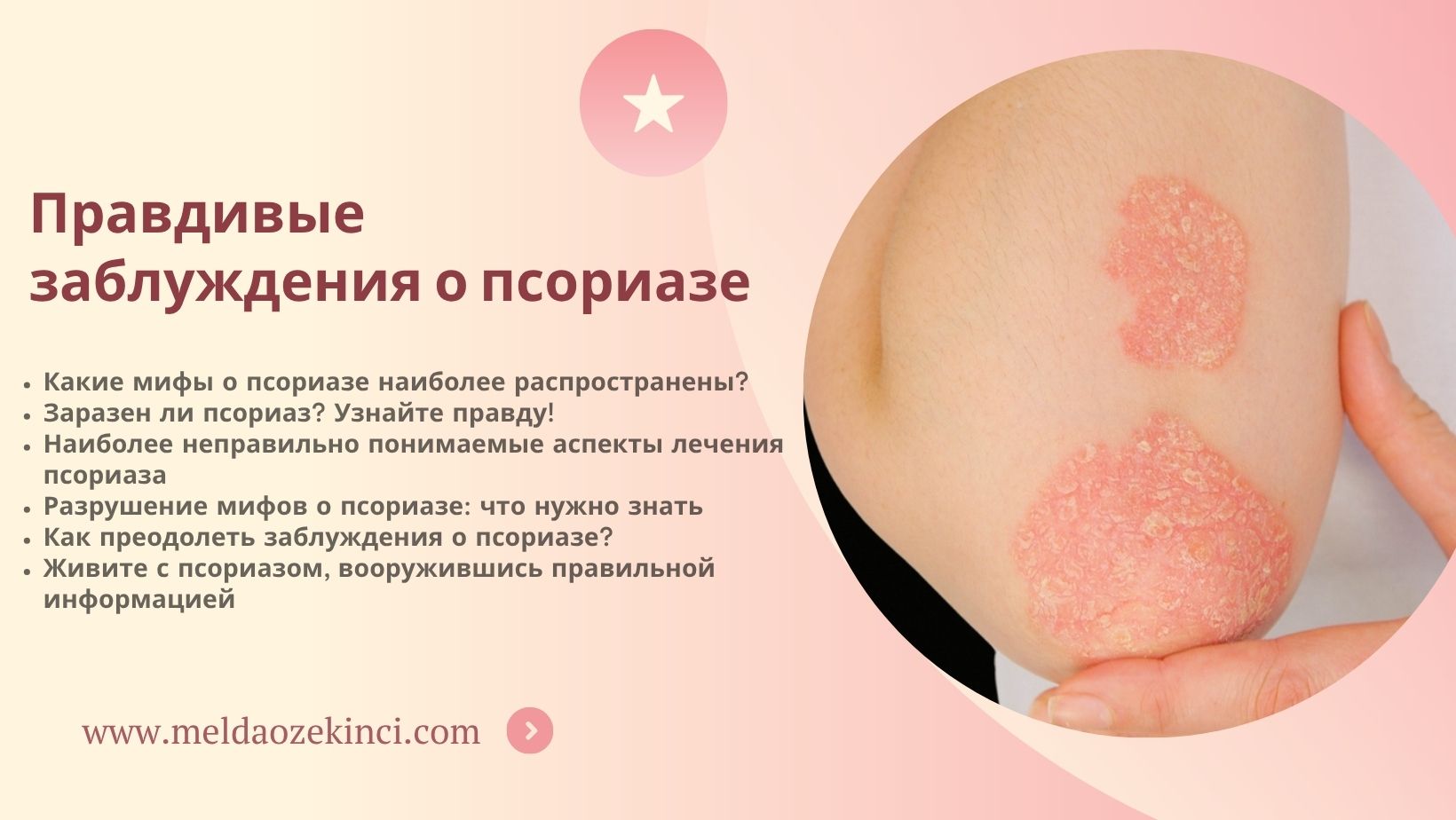 Правдивые заблуждения о псориазе