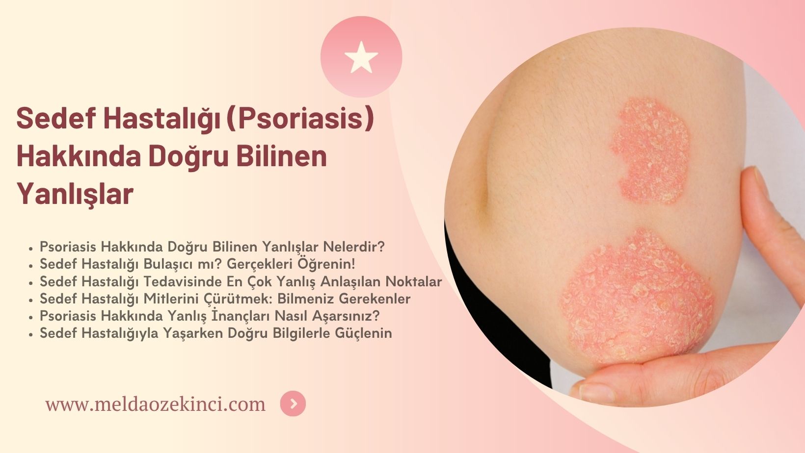 Sedef Hastalığı (Psoriasis) Hakkında Doğru Bilinen Yanlışlar