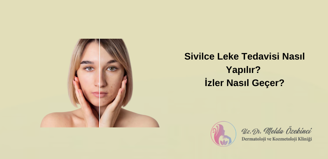 Sivilce İzi Tedavisi Sivilce İzi Tedavisi