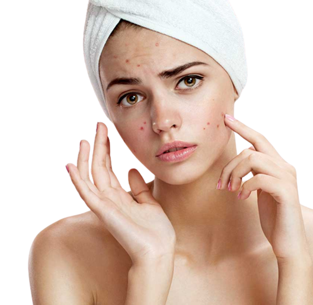 Acne Scar Treatment