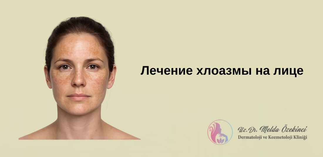 Методы лечения пятен мелазмы на лице