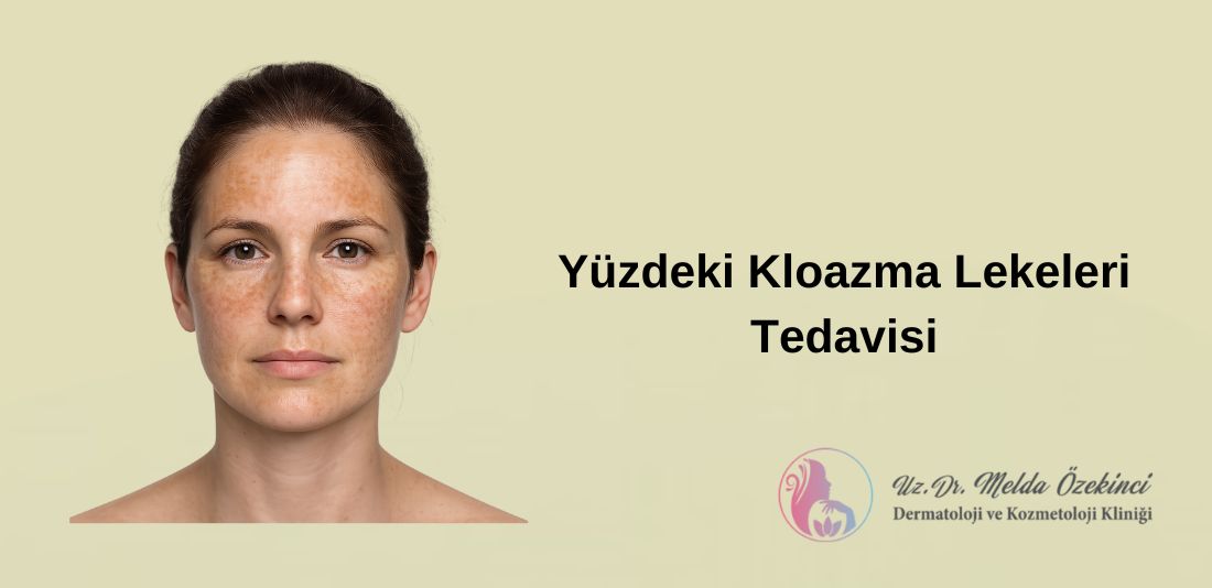 Yüzdeki Kloazma Lekeleri İçin Tedavi Yöntemleri