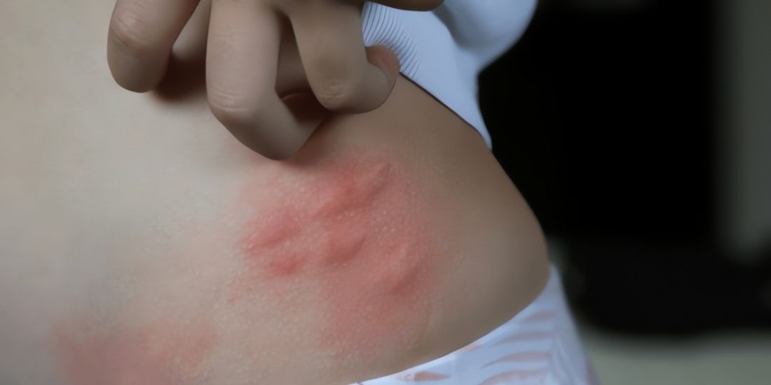 How is Skin Redness Treated?