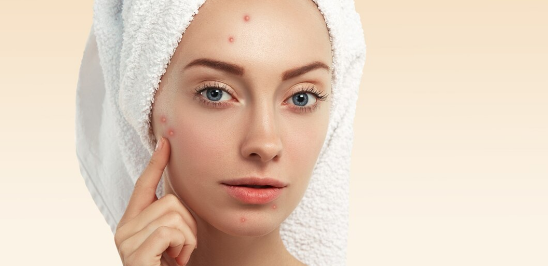 Acne treatment in Antalya: The latest methods and dermatological solutions