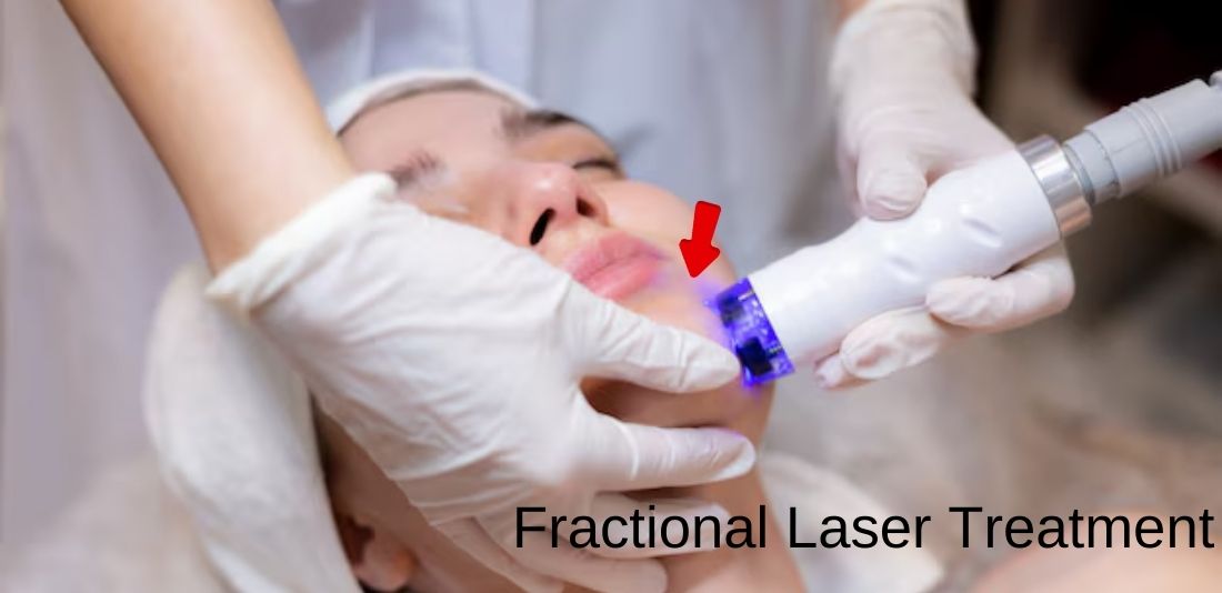 Antalya Fractional Laser Treatment