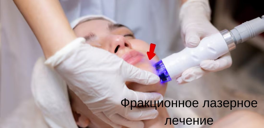 Фракционная лазерная терапия в Анталье