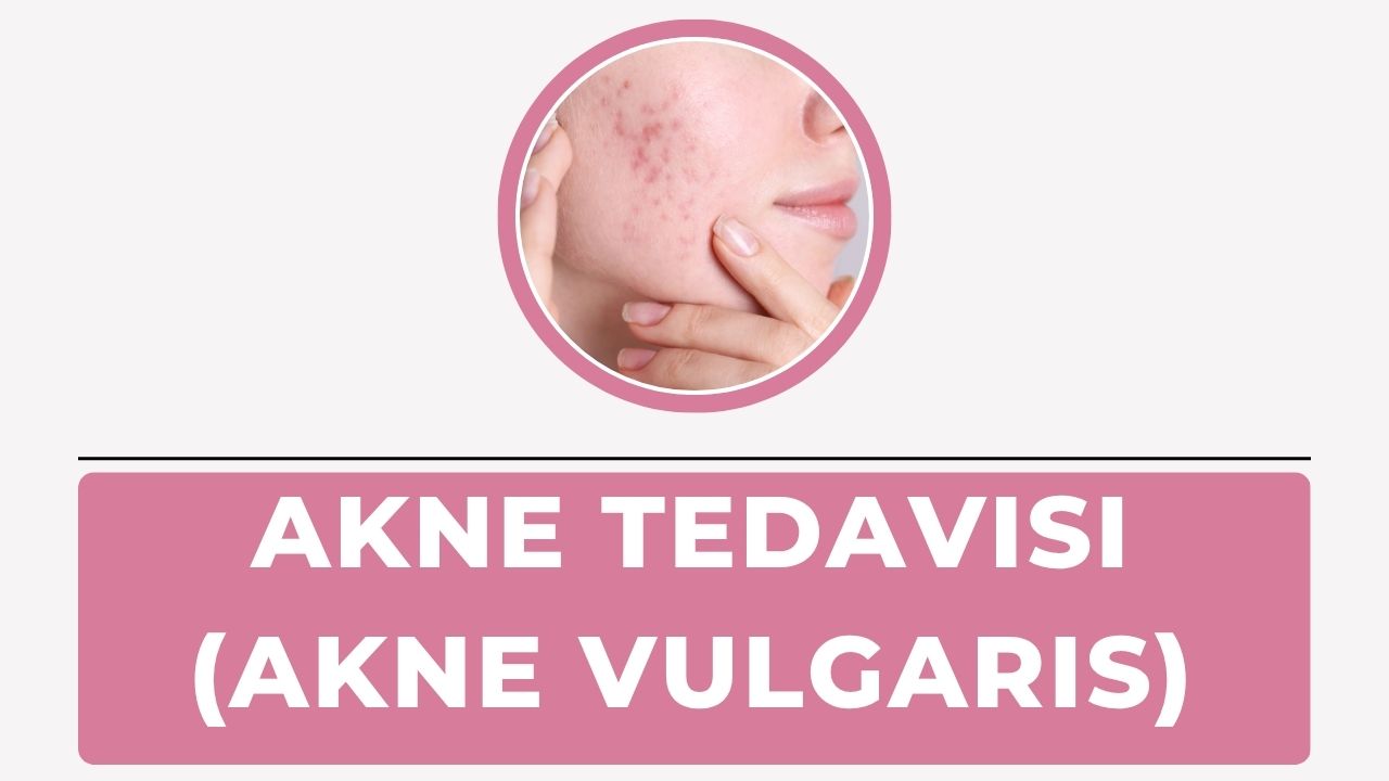 Akne Tedavisi