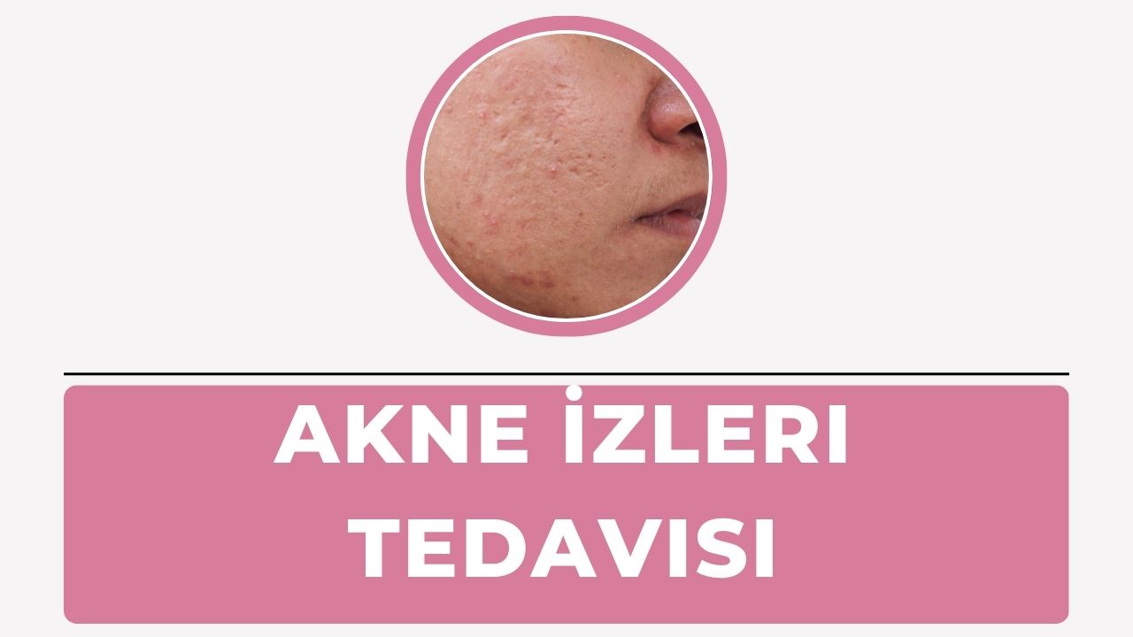 Akne İzleri Tedavisi