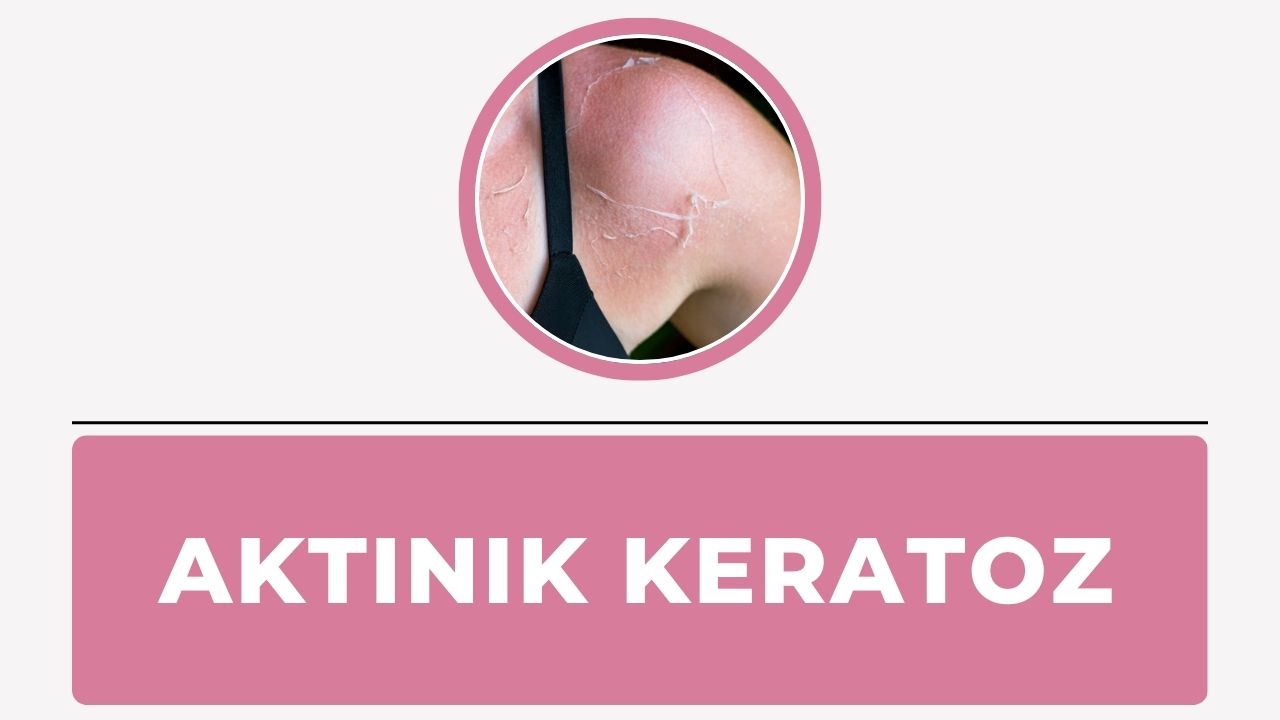 Aktinik keratoz