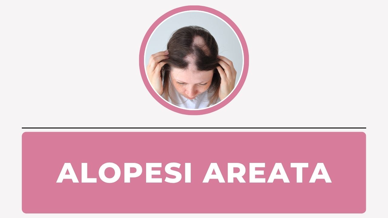 Alopesi Areata