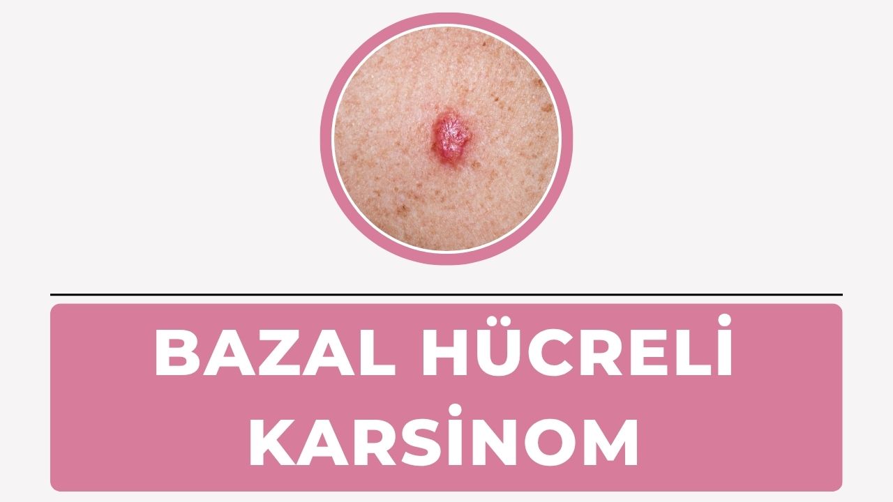 Bazal hücreli karsinom