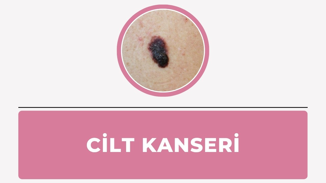 Cilt kanseri