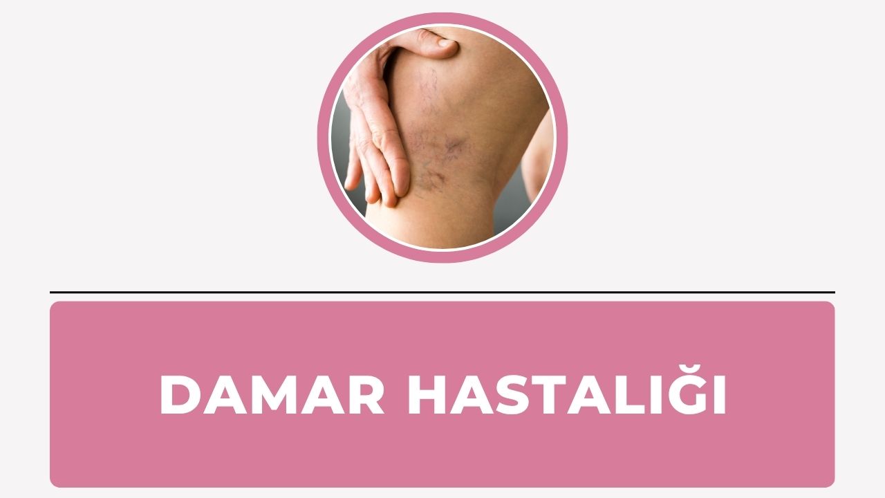 Damar Hastalığı