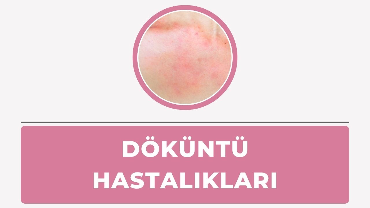 Döküntü Hastalıkları
