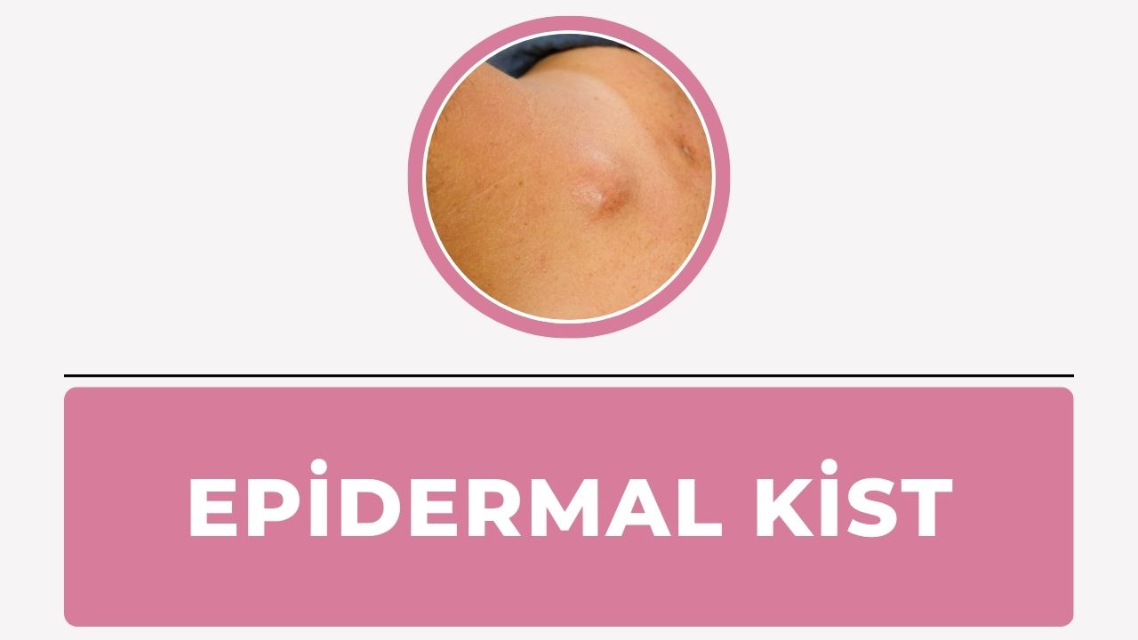 Epidermal Kist