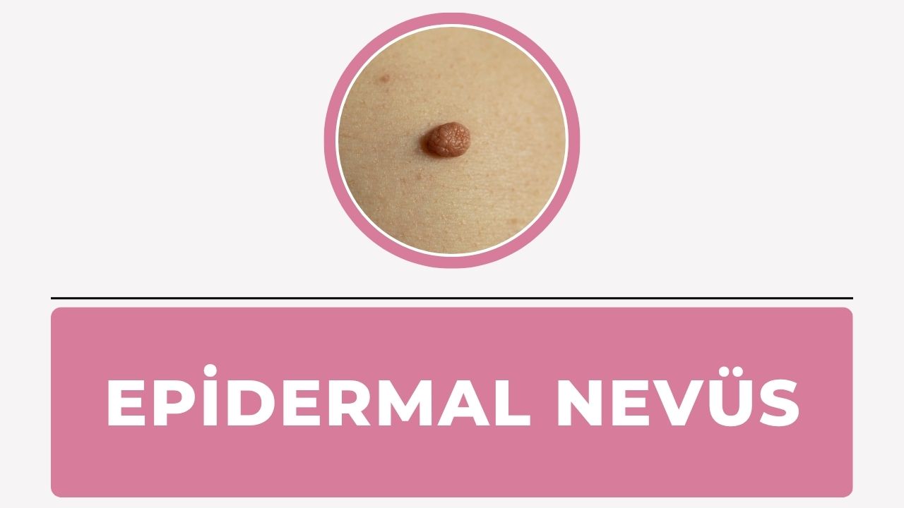 Epidermal Nevüs