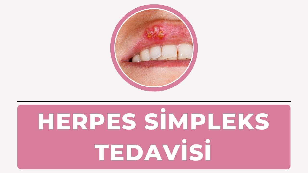 Herpes Simpleks Tedavisi