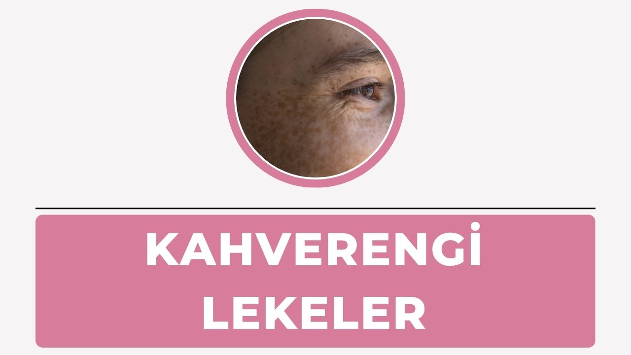 Kahverengi lekeler