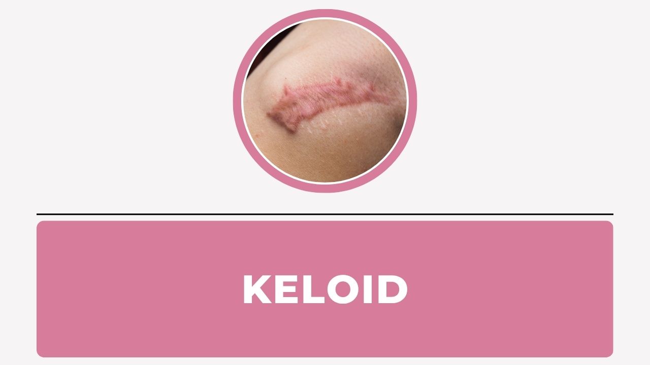 Keloid