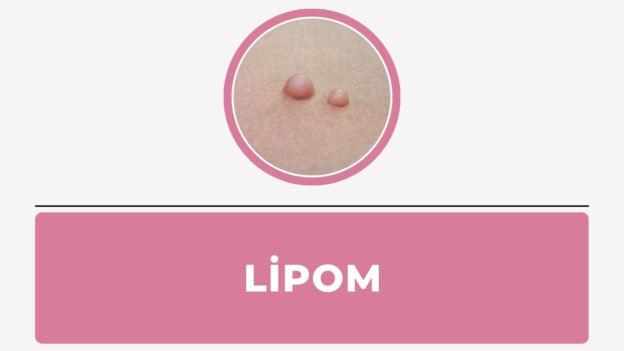 Lipom