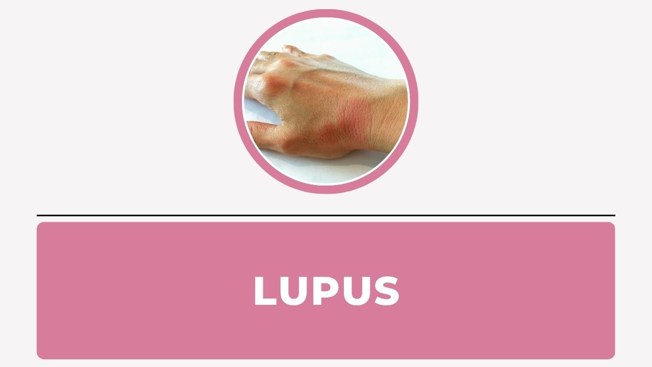 Lupus