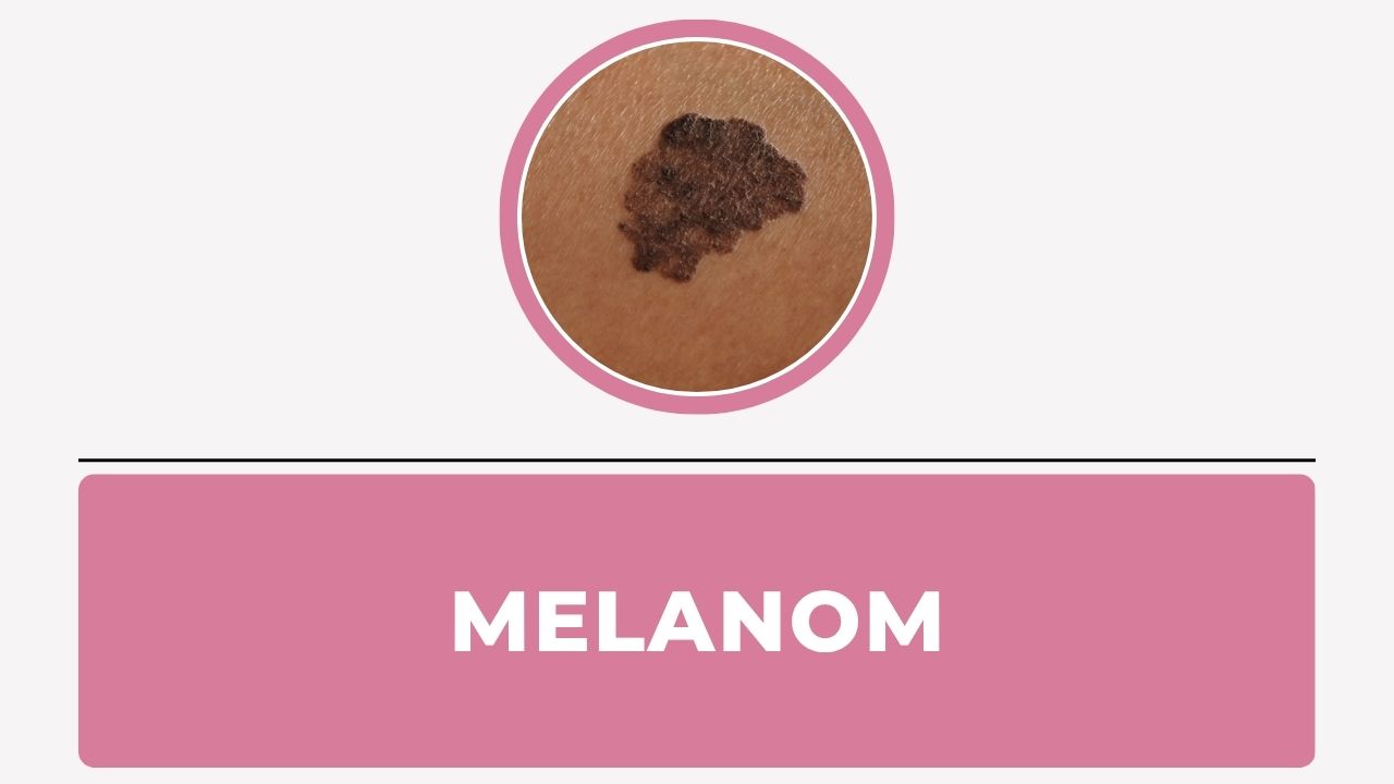 Melanom