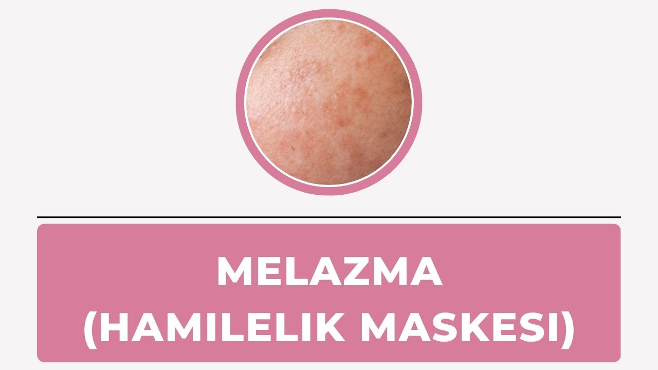 Melazma