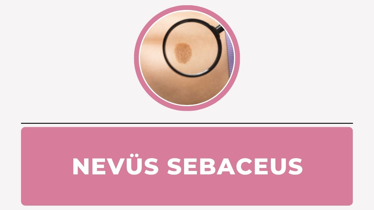 Nevüs Sebaceus