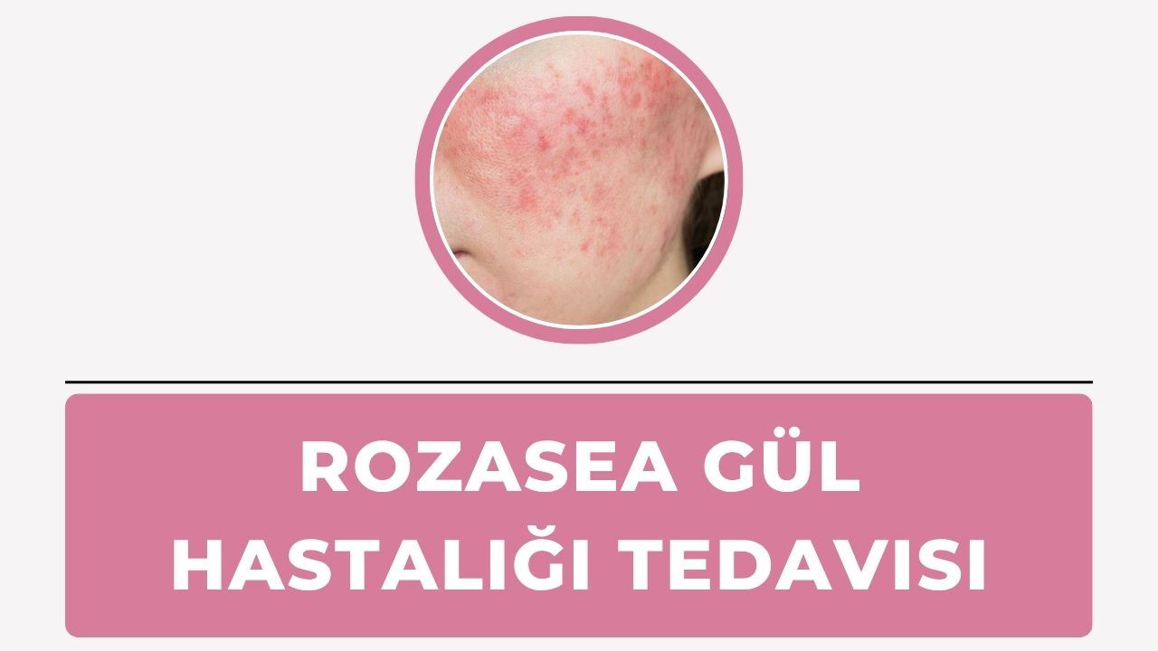 Rozasea Gül hastalığı Tedavisi