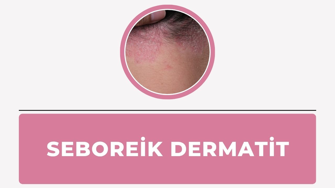 Seboreik Dermatit