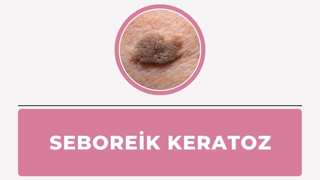 Seboreik keratoz