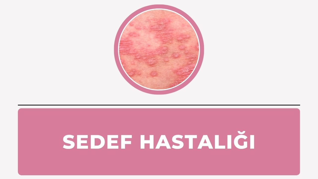 Sedef hastalığı