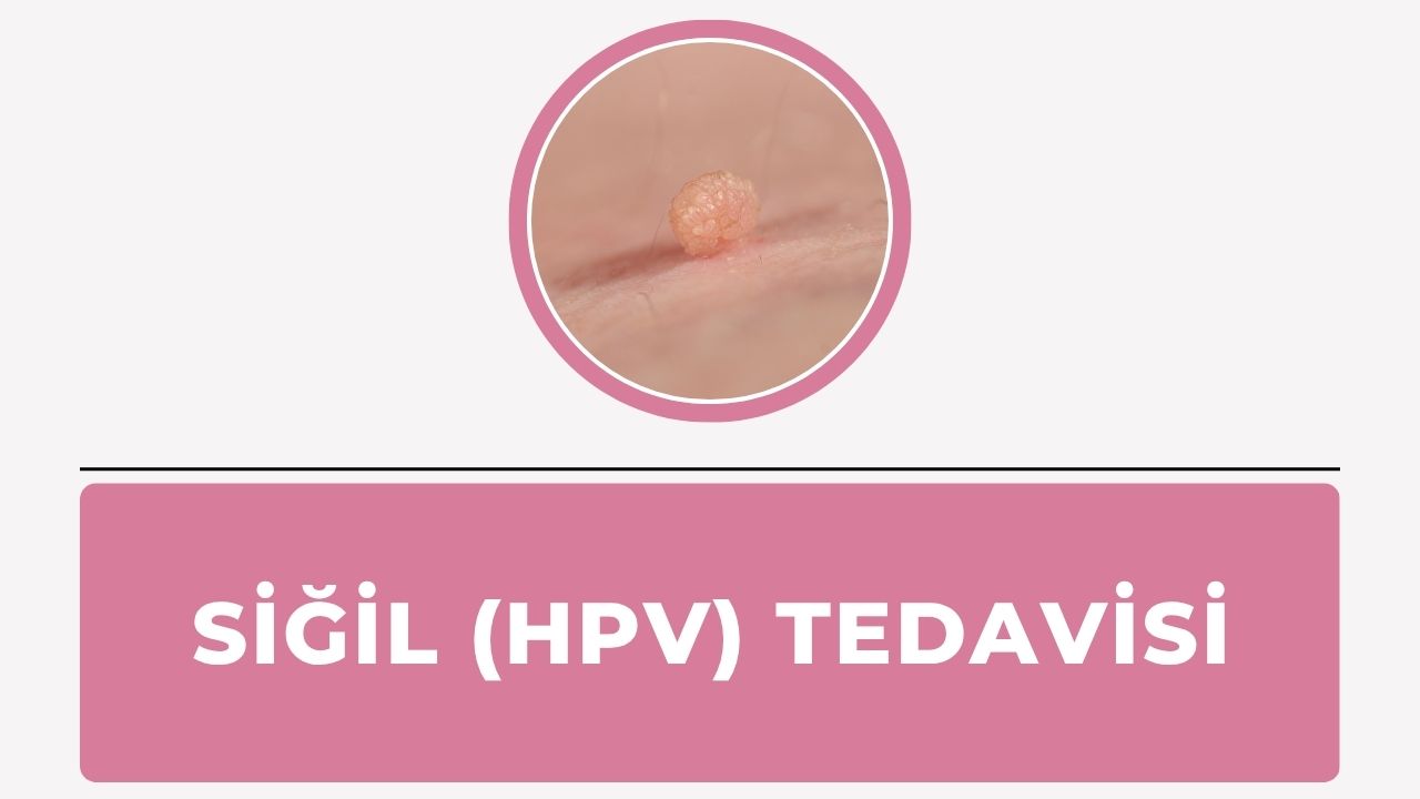 Siğil Tedavisi