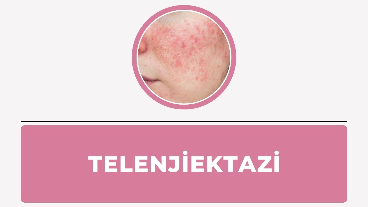 Telenjiektazi