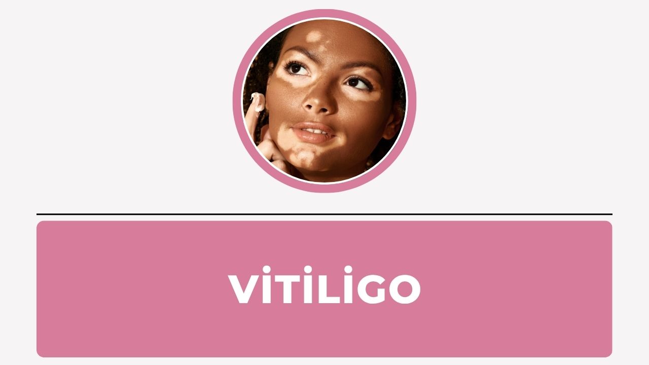 Vitiligo
