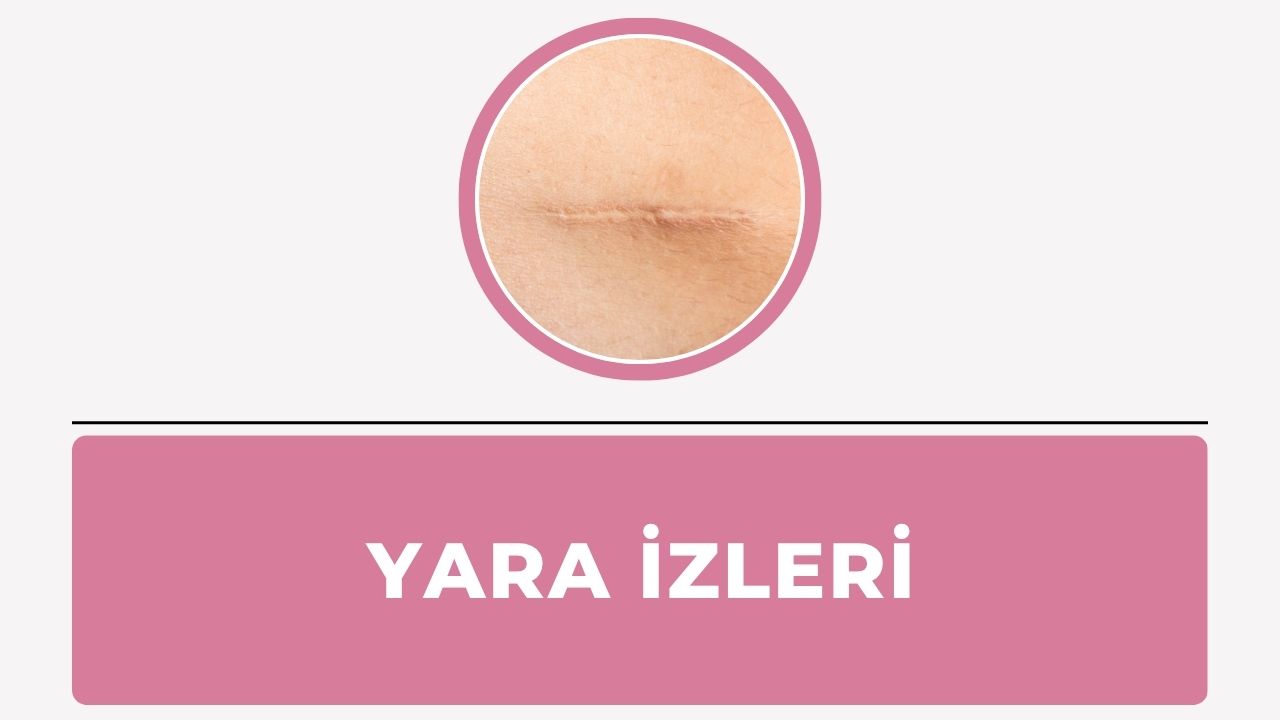 Yara İzleri