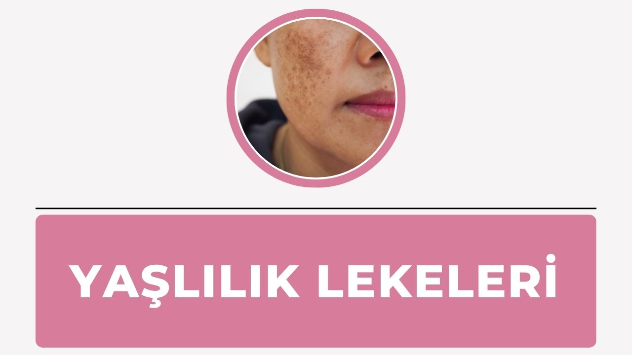 Yaşlılık lekeleri