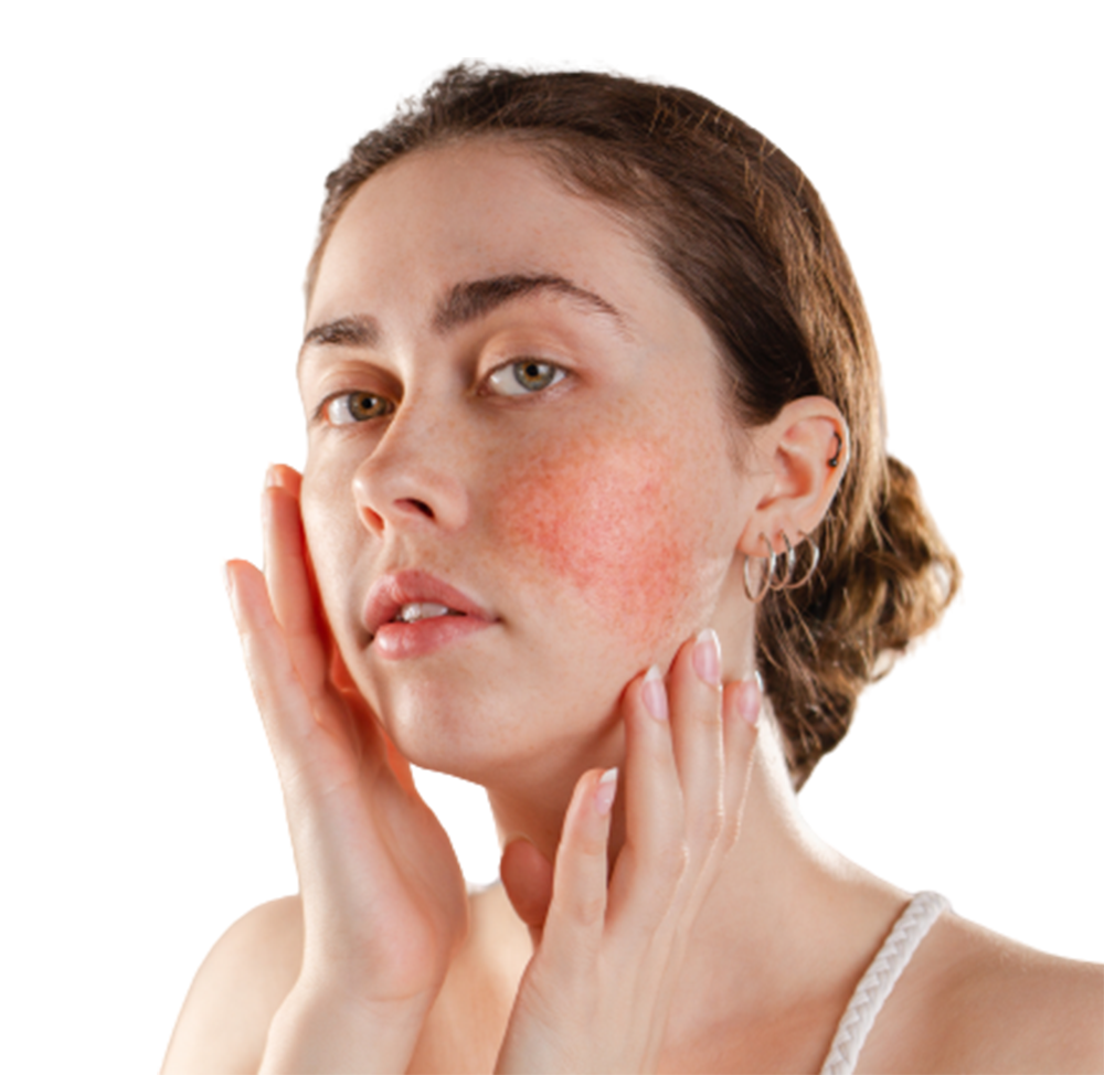 Rosacea - Rose Disease Treatment